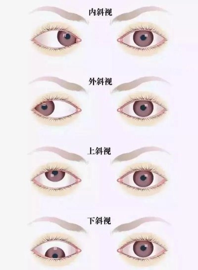 愛爾眼科：總愛偏頭看，視力“一好一壞”？警惕斜視！(圖1)